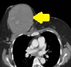 EWING'S BREAST SARCOMA