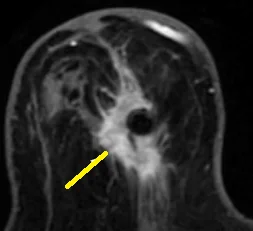 BREAST FAT NECROSIS