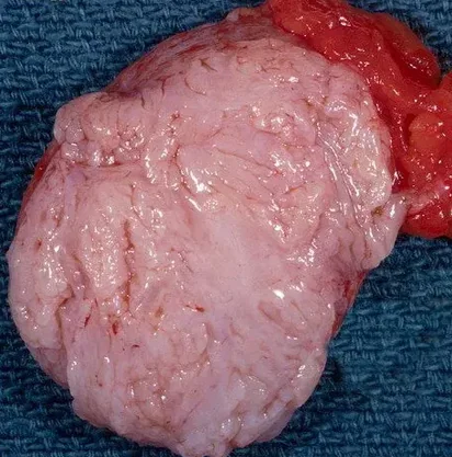 BREAST FIBROADENOMA