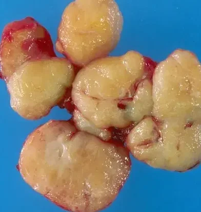 BREAST FIBROADENOMA