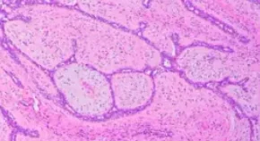 BREAST FIBROADENOMA 