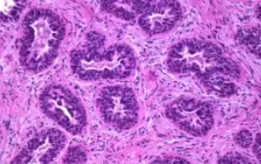 BREAST FIBROADENOMA