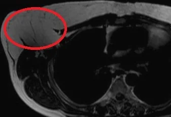 GIANT BREAST LIPOMA