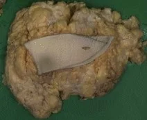 GIANT BREAST LIPOMA