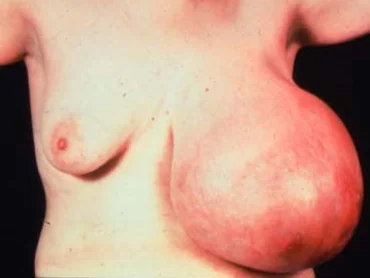 GIANT FIBROADENOMA