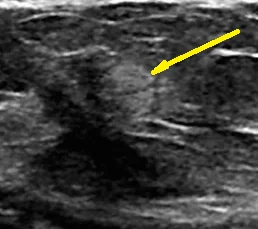 GRANULAR CELL BREAST TUMOR