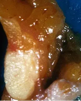 GRANULAR CELL TUMOR