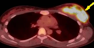 GRANULOMATOUS MASTITIS