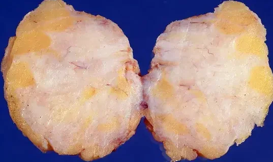GYNECOMASTIA
