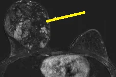 BREAST HAMARTOMA