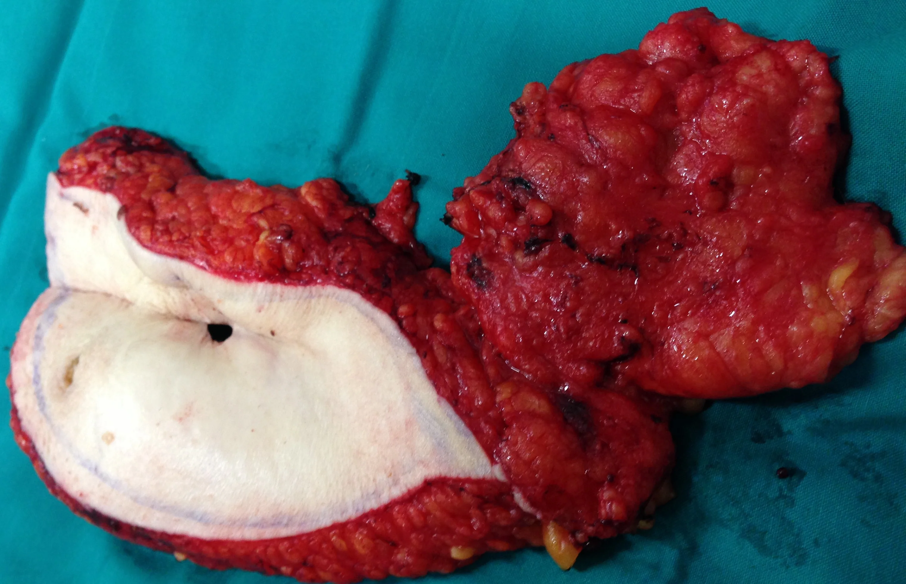 SIMPLE MASTECTOMY - AXILLARY LYMPH NODE CLEARANCE