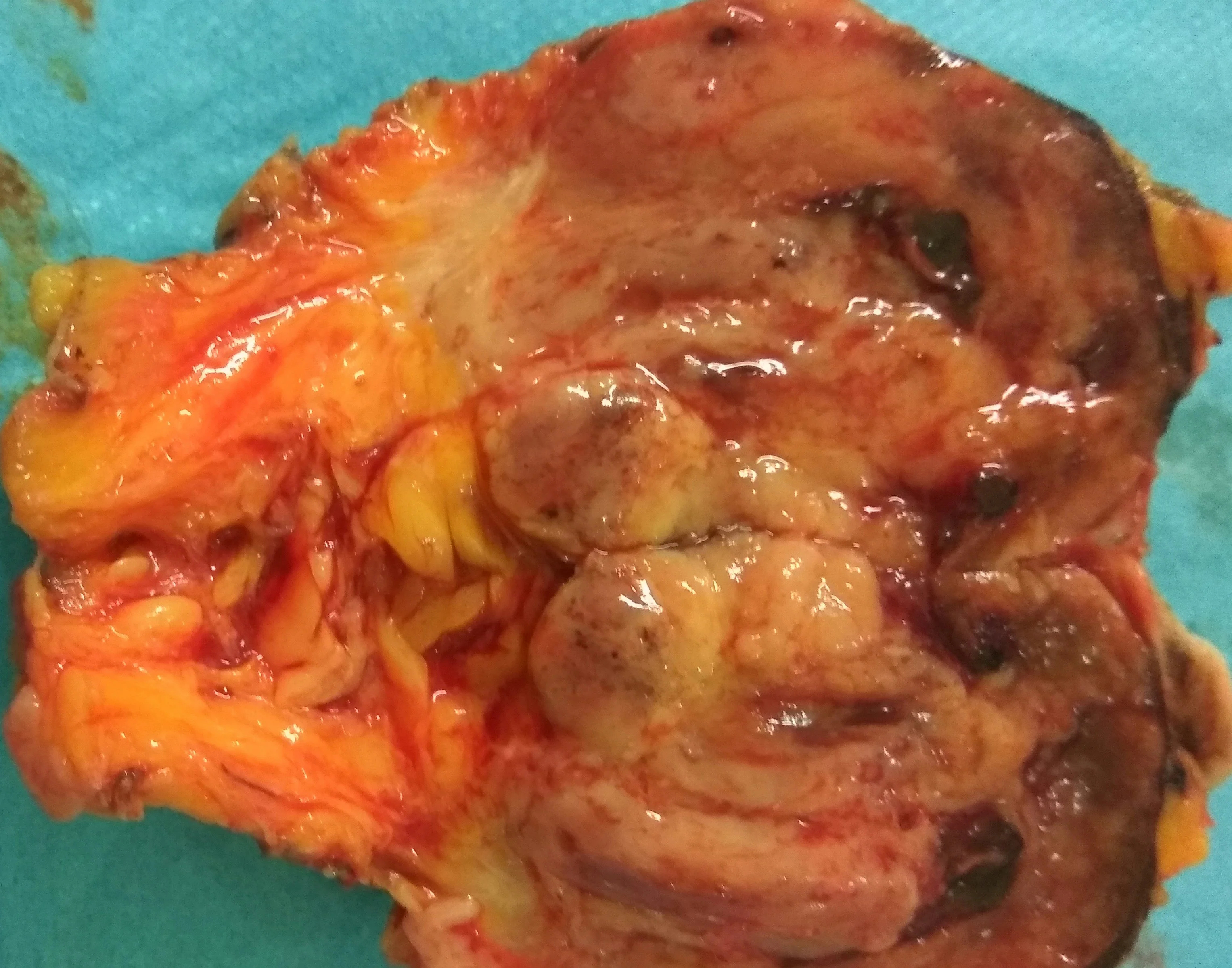 INFILTRATED AXILLARY LYMPH NODES