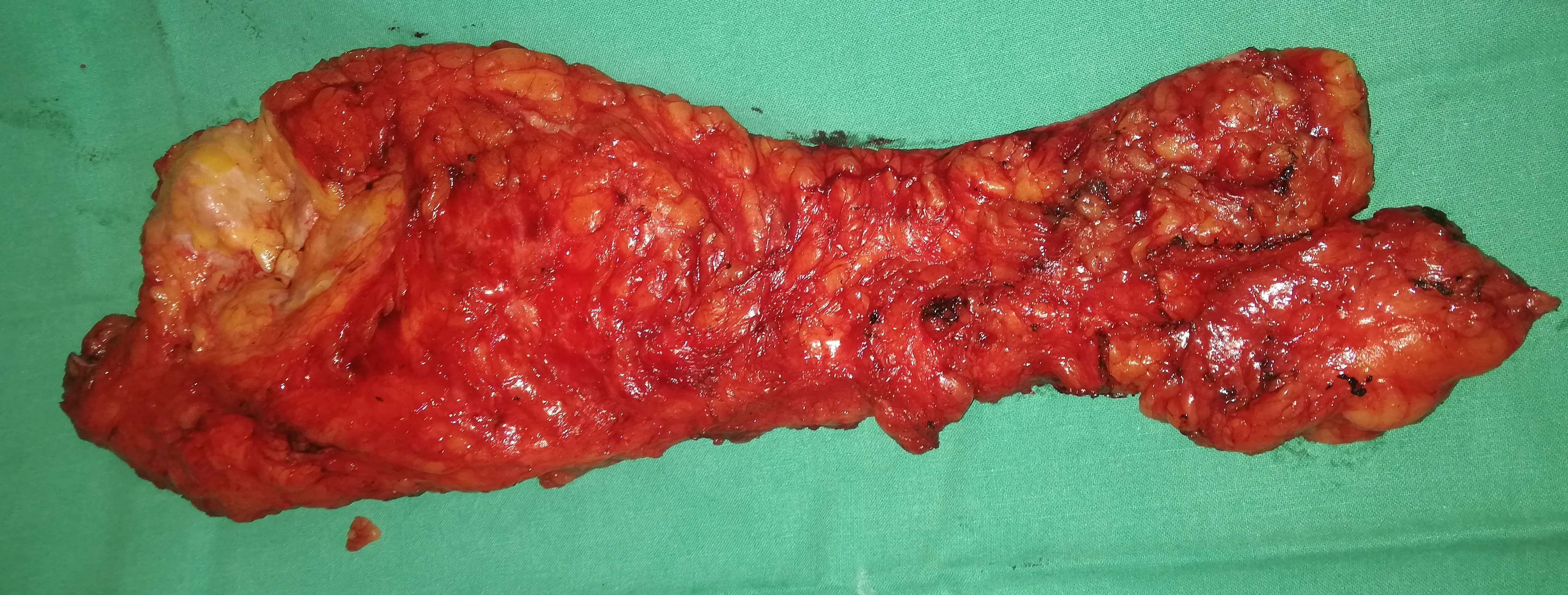 SIZEABLE BREAST CARCINOMA