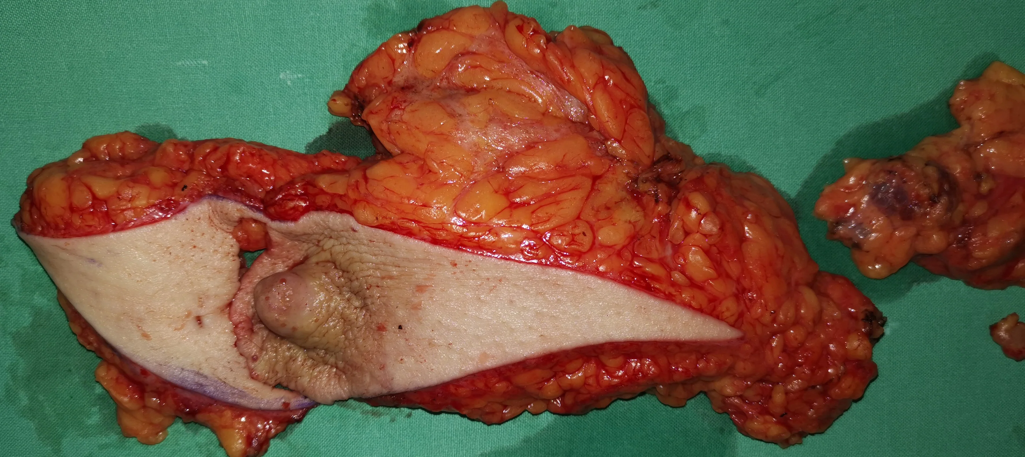 SIMPLE MASTECTOMY - AXILLARY LYMPH NODE CLEARANCE