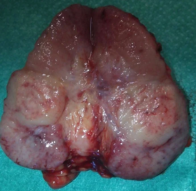 INFILTRATED AXILLARY LYMPH NODES