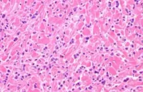 INFILTRATING LOBULAR CARCINOMA
