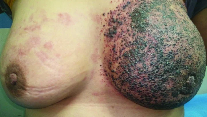 INFLAMMATORY BREAST CARCINOMA