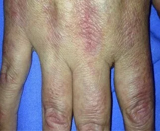 INFLAMMATORY BREAST CARCINOMA - MYOSITIS