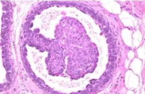 INTRADUCTAL PAPILLOMA