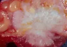 INVASIVE DUCT CARCINOMA