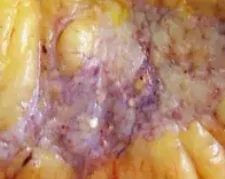 INVASIVE DUCTAL CARCINOMA