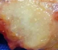 INVASIVE DUCTAL CARCINOMA 