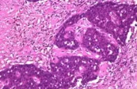 INVASIVE PAPILLARY CARCINOMA