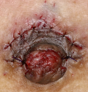 INVERTED NIPPLE REPAIR