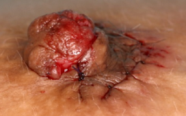 INVERTED NIPPLE REPAIR