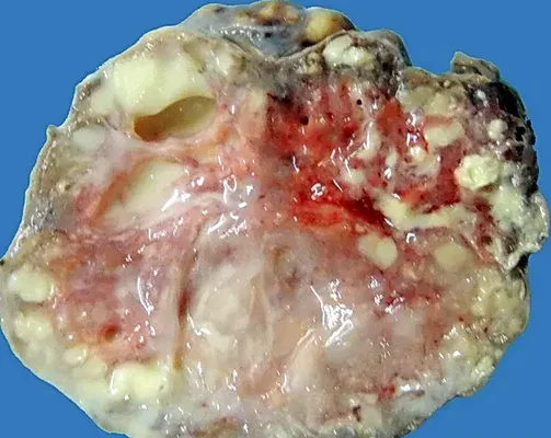 LACTATING ADENOMA
