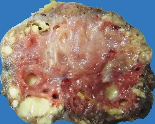 LACTATING ADENOMA 