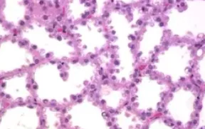 LACTATING ADENOMA 