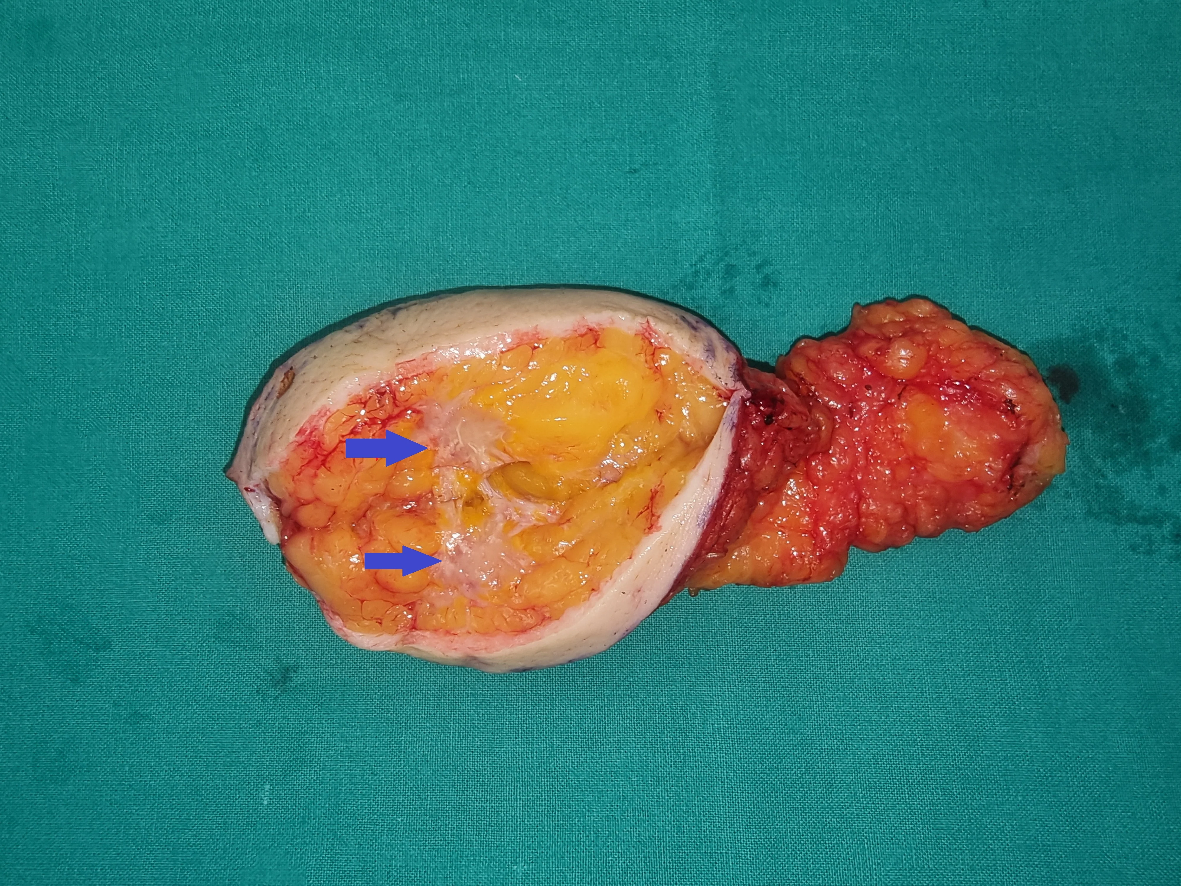 LATE RECURRENCE LOBULAR BREAST CARCINOMA