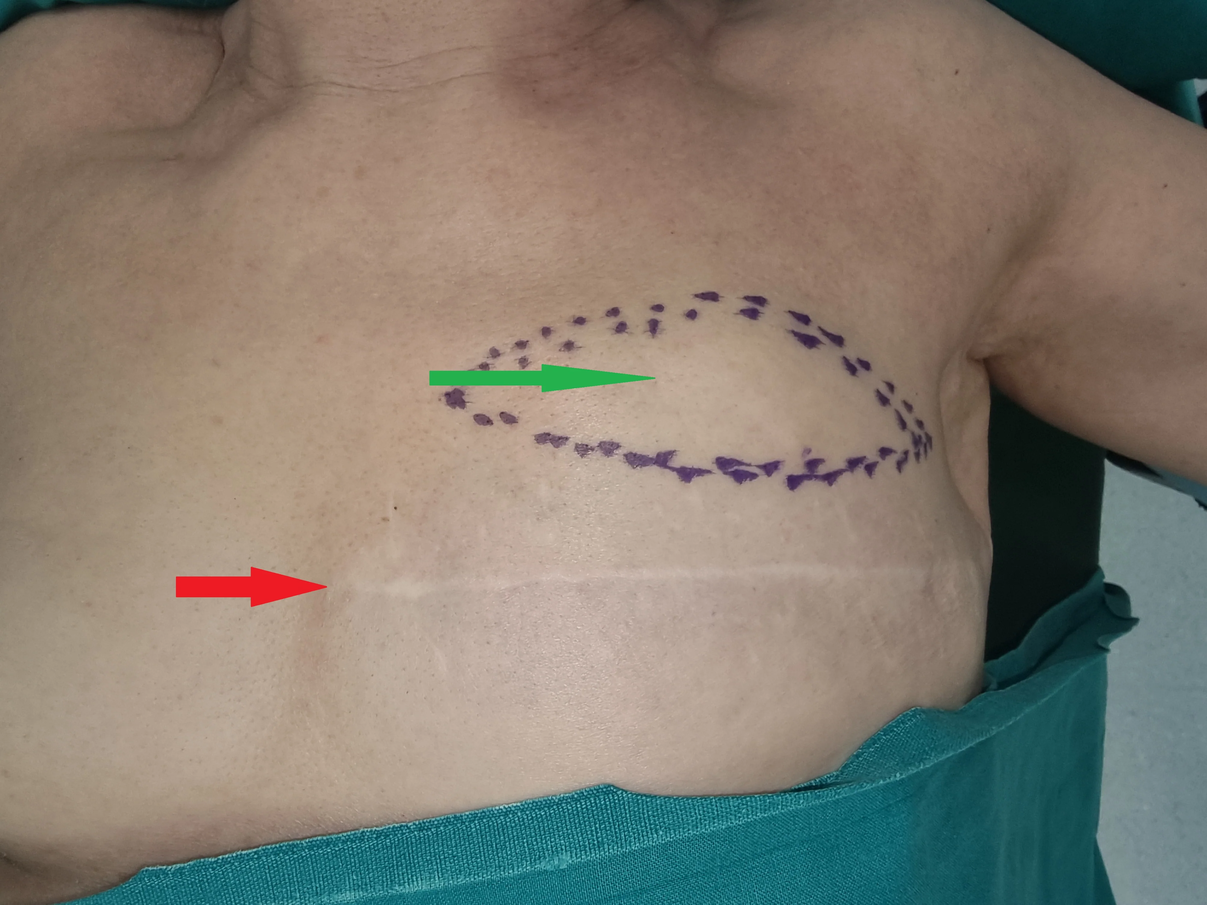 LATE RECURRENCE LOBULAR BREAST CARCINOMA