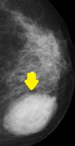 BREAST LIPOSARCOMA