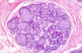 LOBULAR CARCINOMA IN SITU