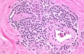 LYMPHOCYTIC MASTITIS
