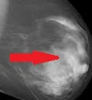 LYMPHOCYTIC MASTITIS 