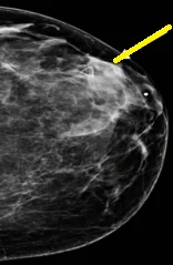 LYMPHOCYTIC MASTOPATHY