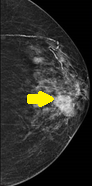 BREAST LYMPHOMA