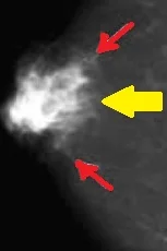 MALE BREAST CARCINOMA