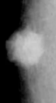 MALE BREAST CARCINOMA