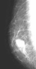 MALE BREAST CARCINOMA