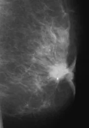 MALE BREAST CARCINOMA 