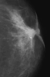 MALE BREAST CARCINOMA