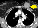 MALIGNANT BREAST PHYLLODES