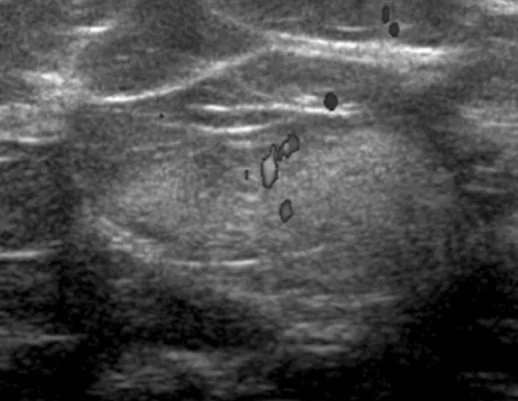 MAMMARY HIBERNOMA