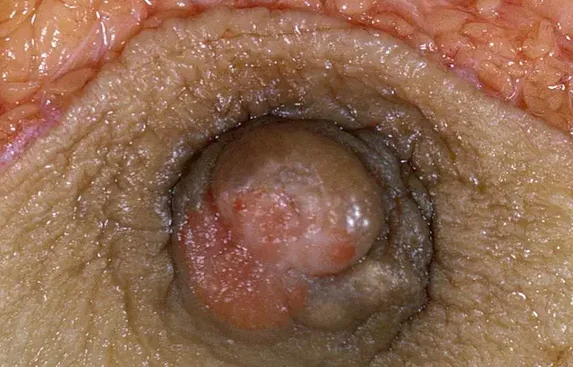 MAMMARY PAGET'S DISEASE 