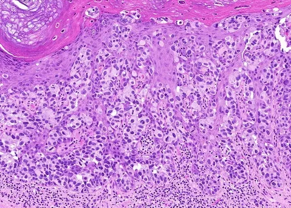 MAMMARY PAGET'S DISEASE