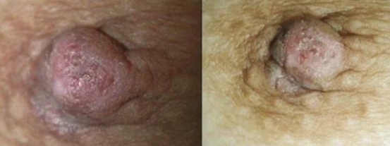 MAMMARY PAGET'S DISEASE